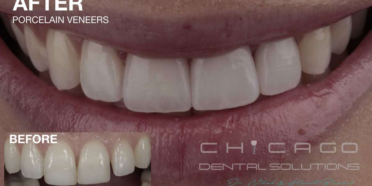Pro Are Teeth Veneers Expensive License Cracked Utorrent