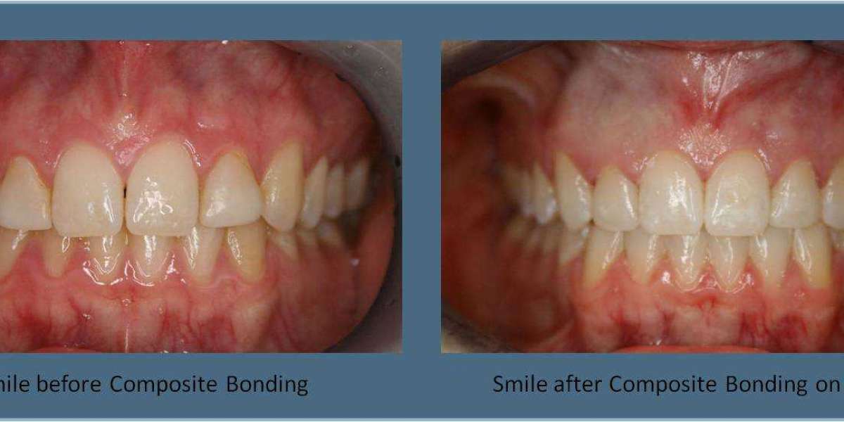 Are Teeth Veneers Expensive Full License Exe Pc Keygen