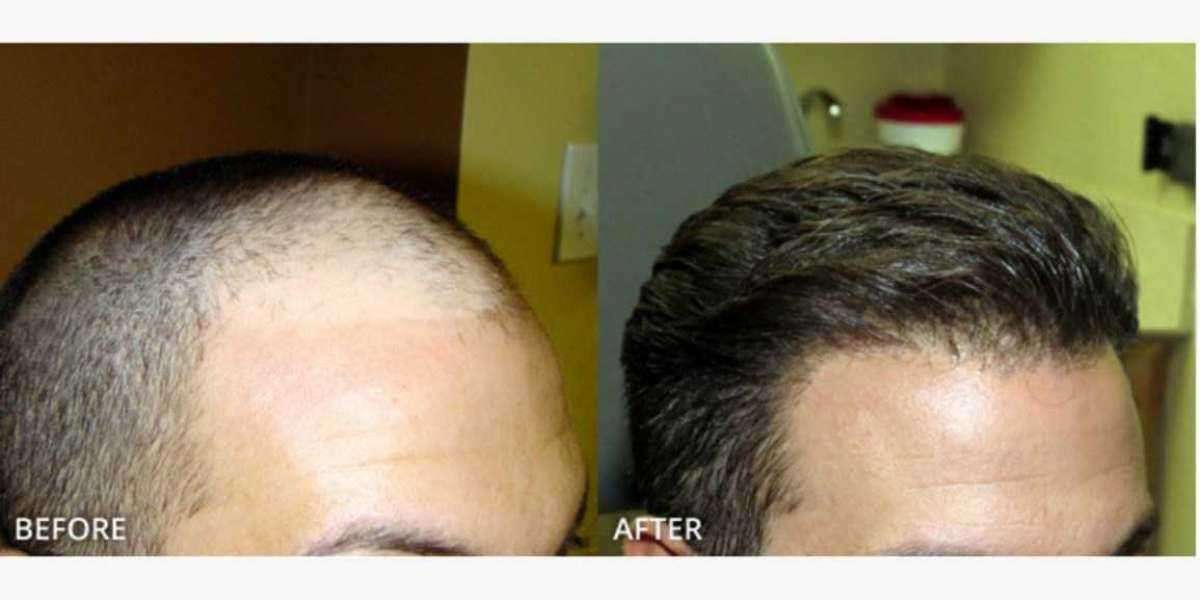 FUE Hair Transplant Cost