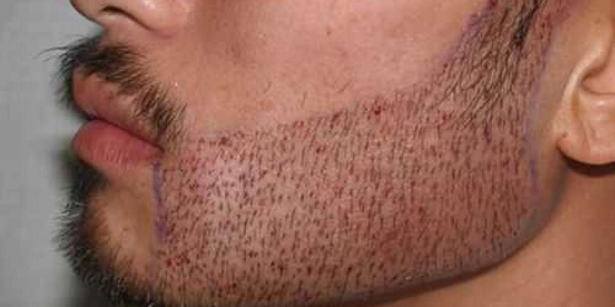 What is the Procedure for a Beard Transplant in Beverly Hills?