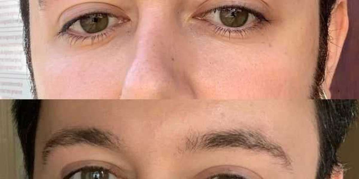 Male Eyebrow Transplant