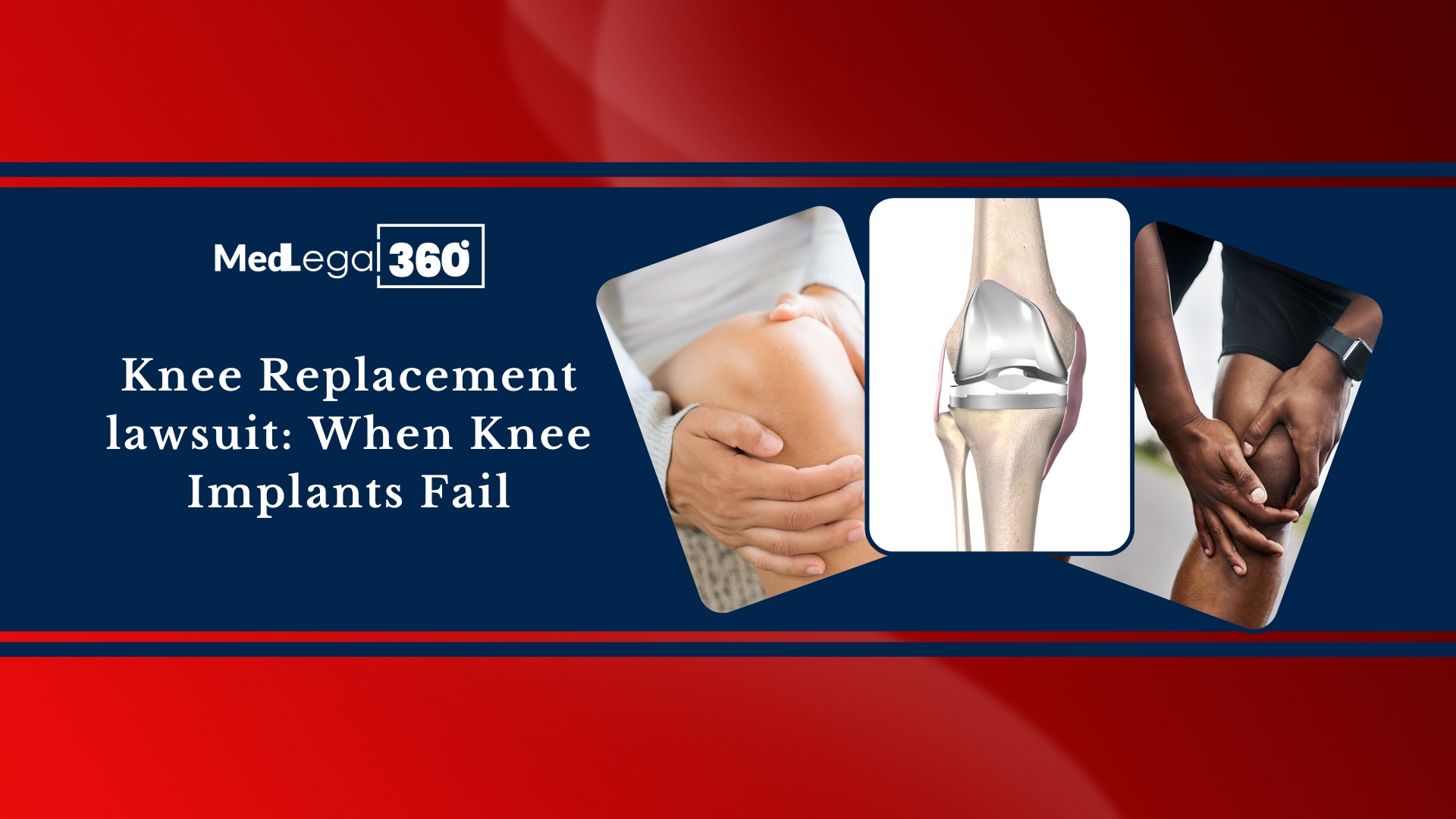 Knee Replacement lawsuit: When Knee Implants Fail