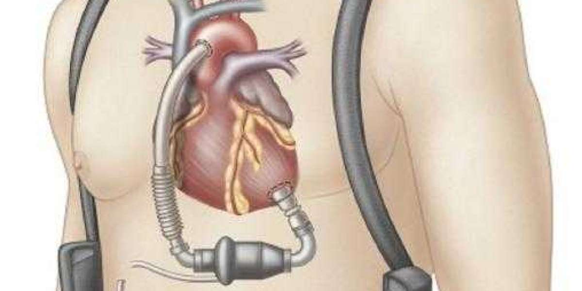 Ventricular Assist Devices Market Size, Industry Shares 2023, Revenue, Future Demand, Growth Statistics, Status, and For