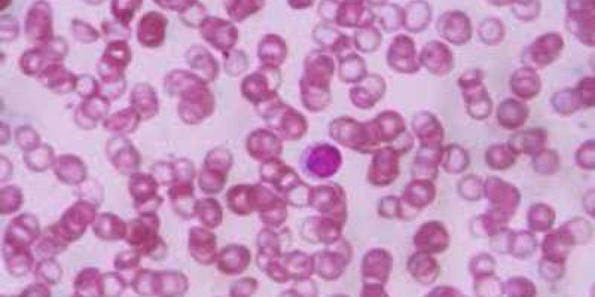 Sickle Cell Disease Diagnosis Market Size Growing at 7.8% CAGR Set to Reach USD 7.9 Billion By 2028