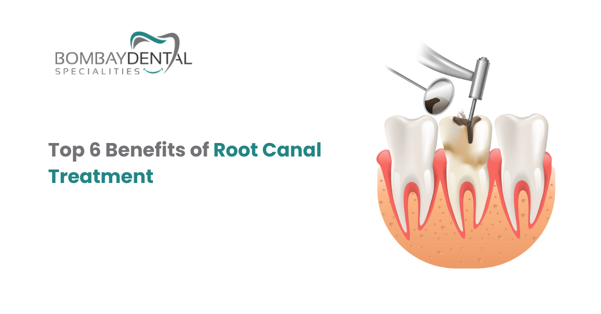 Top 6 Benefits of Root Canal Treatment