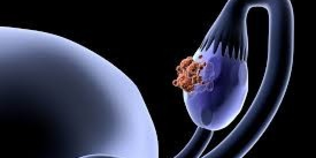 2023, Fallopian Tube Cancer Market Research Report Analysis by 2033