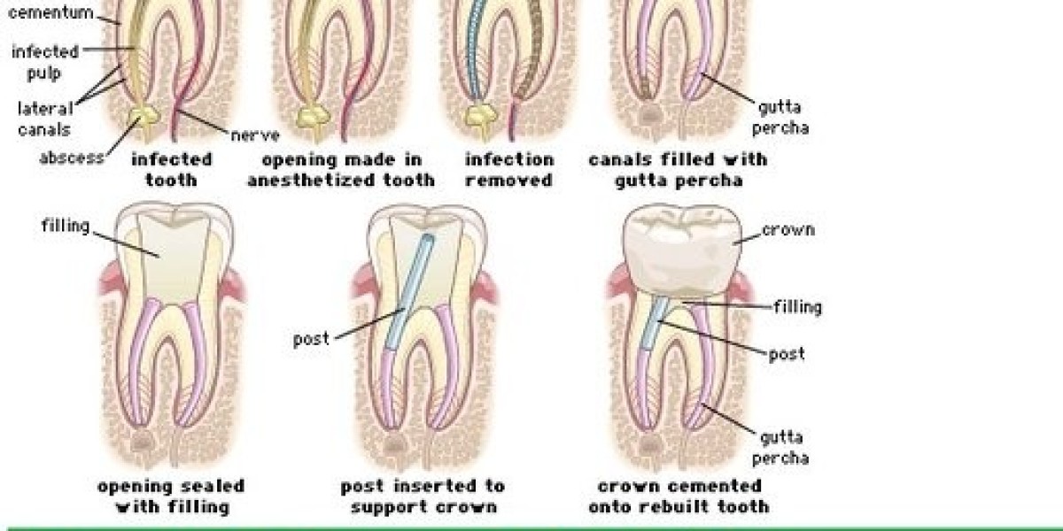 What are the root canal treatment steps?