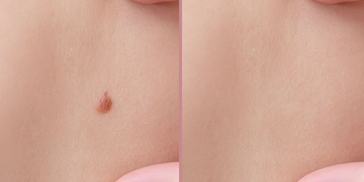 Can Moles be permanently removed?