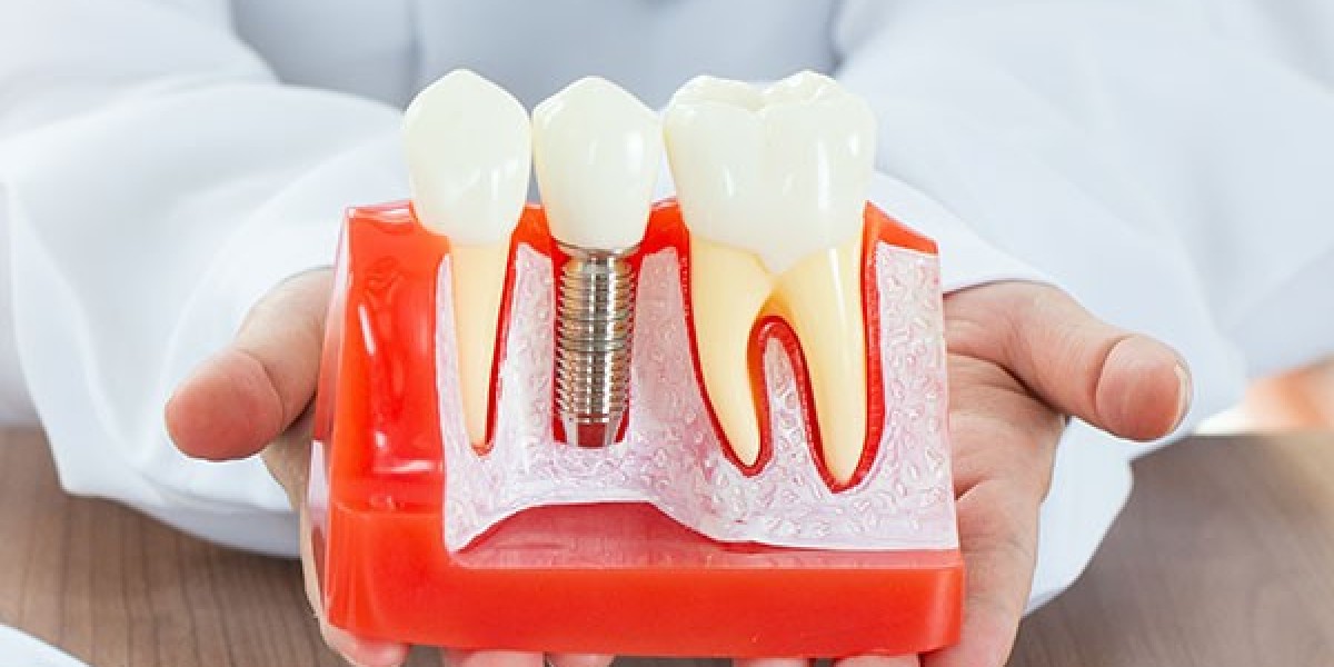 How do I Care for Dental Implants?