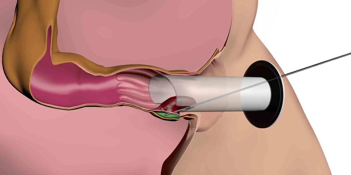 Patient Experience to Hold the Key to Global Hemorrhoid Treatment Devices Market Research