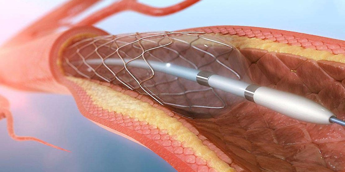 Cerebral Vascular Stent Market Research Report on Industry Trends and Segmental Analysis