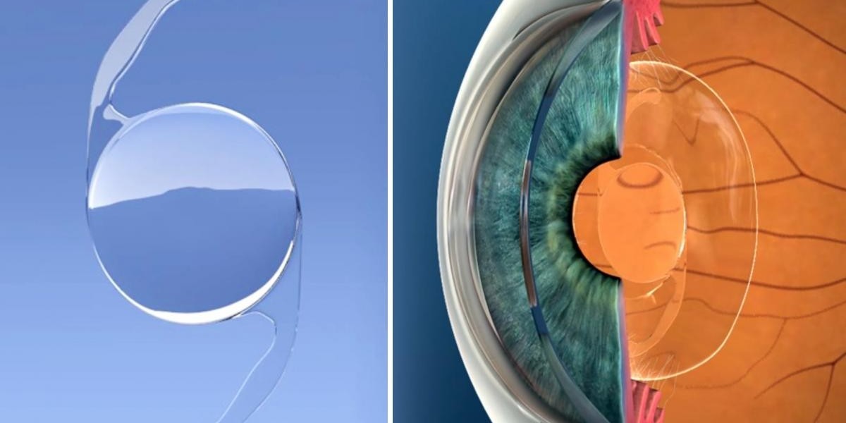 Intraocular Lens Market Research on Regional Segmentation And Competitions