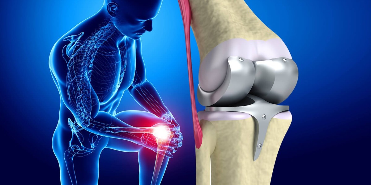 Global Knee Replacement Market Trends to be Led by North America During Review Period