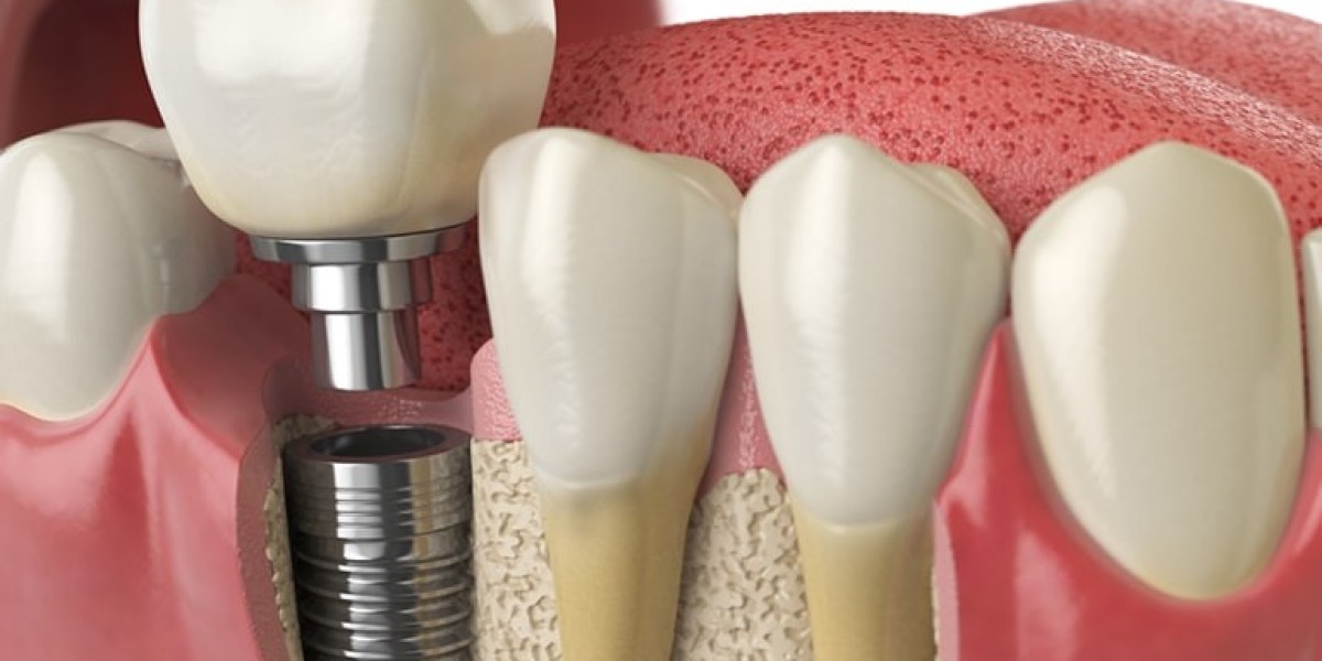 Exploring Dental Implants Cost in Canada