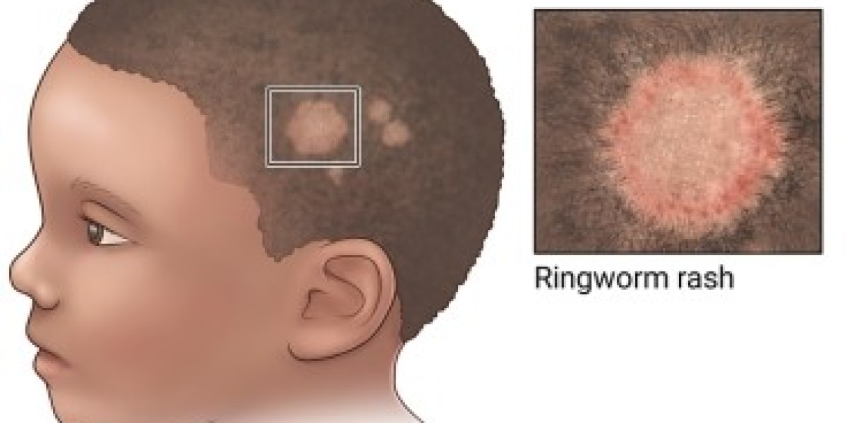 Ringworm Infections: Prevention, Diagnosis, and Management