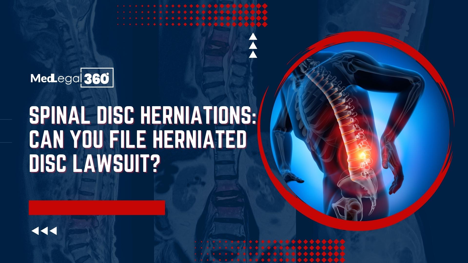 Spinal Disc Herniations: Herniated Disc Lawsuit Updates