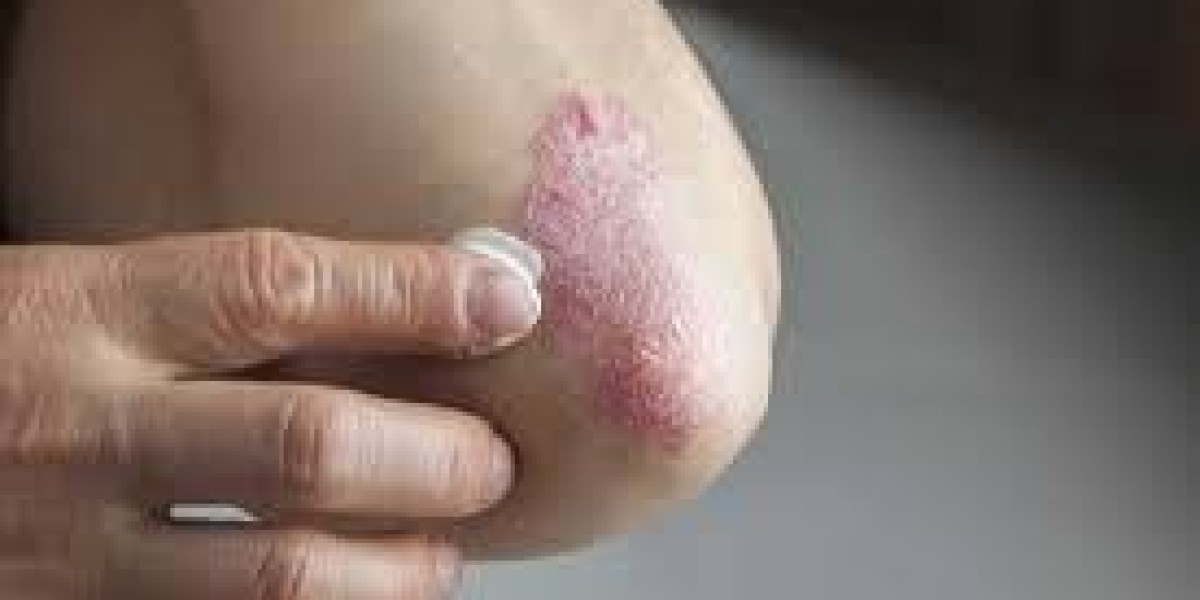 Psoriasis Market Analysis, Epidemiology, Trends, Size, Share, and Future Forecast till (2023-2033)