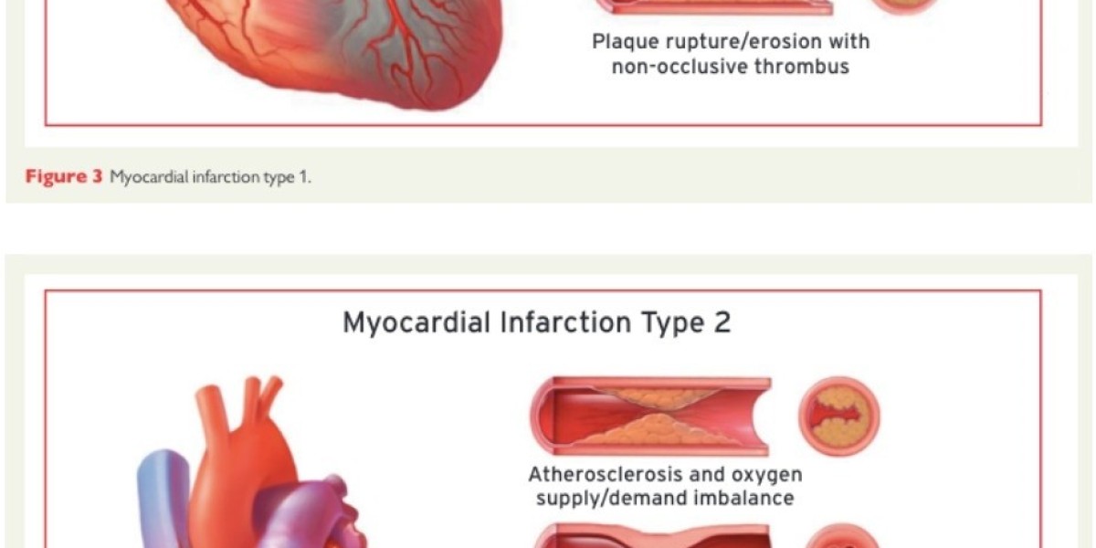 From Diagnosis to Recovery: Navigating Myocardial Infarction