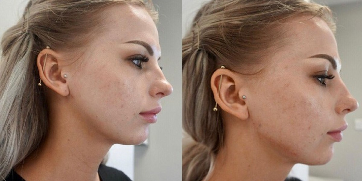 Enhancing Facial Features with Jawline Filler and Cheek Filler