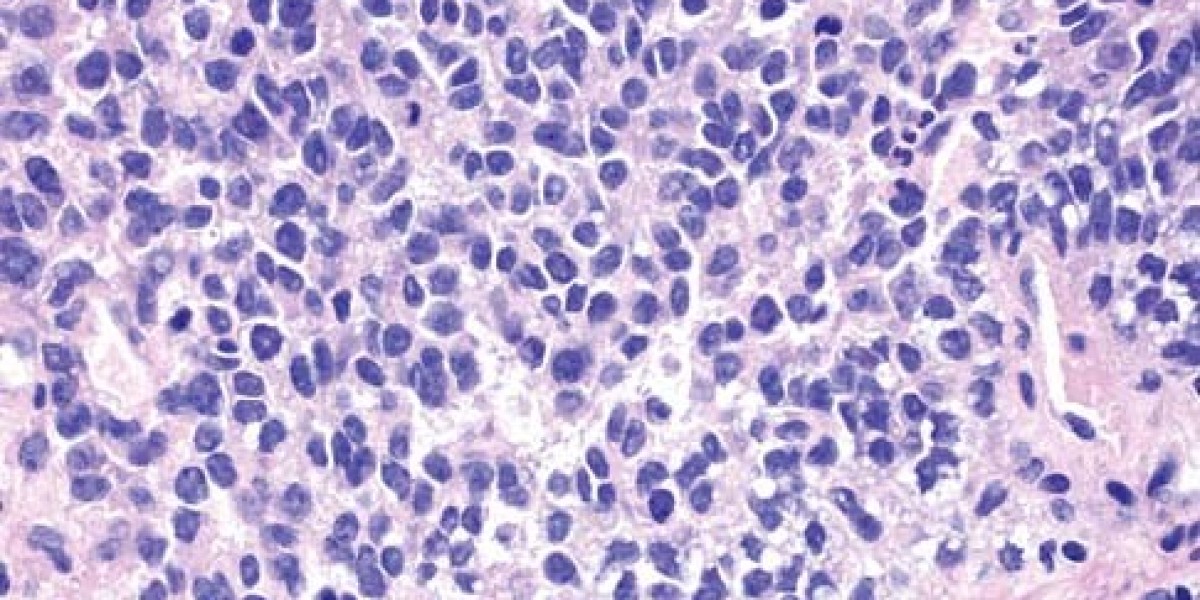 2023 Ewing’s Sarcoma Market | Report By 2033