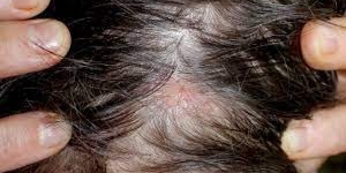 2023, Hair Diseases Market Research Report Analysis by 2033