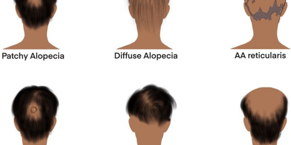 Alopecia Areata Market Size and Growth Rate Analysis for 2023-2033| by IMARC Group