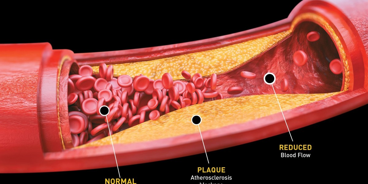 Arteriosclerosis Disease: From Causes to Cutting-Edge Treatments
