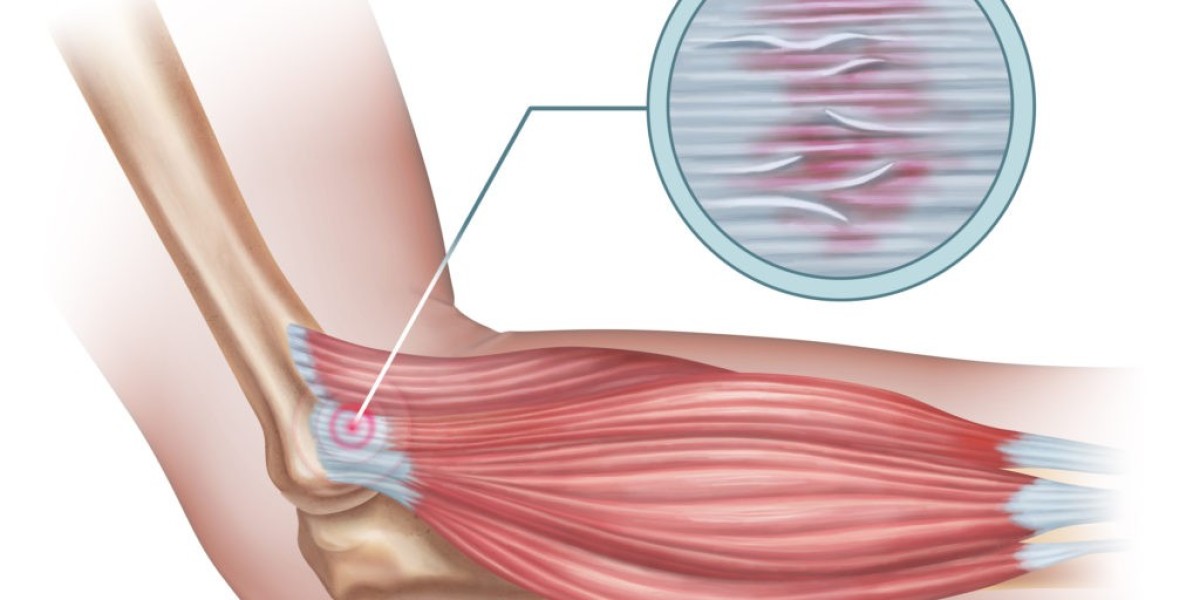 Tendinopathy Market Analysis Report 2024 Along with Statistics, Forecasts till 2034