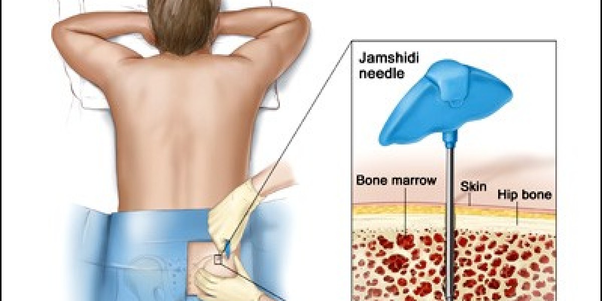 How to reduce bone marrow pain with "Aspadol 200"