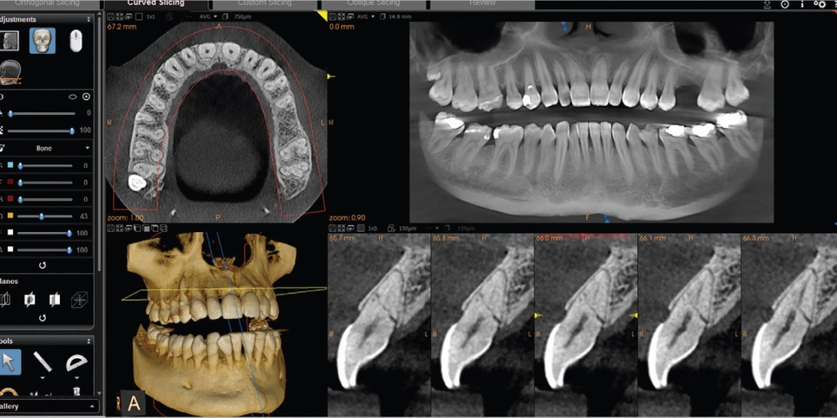 Advancing Dental Care: Exploring Cone Beam Dental X-ray Systems in the CBCT Dental Imaging Market