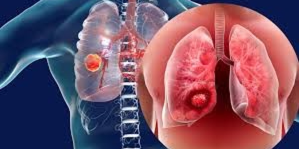 Screening For Lung Cancer Like We Do For Colon And Breast Cancer? The Time Has Come