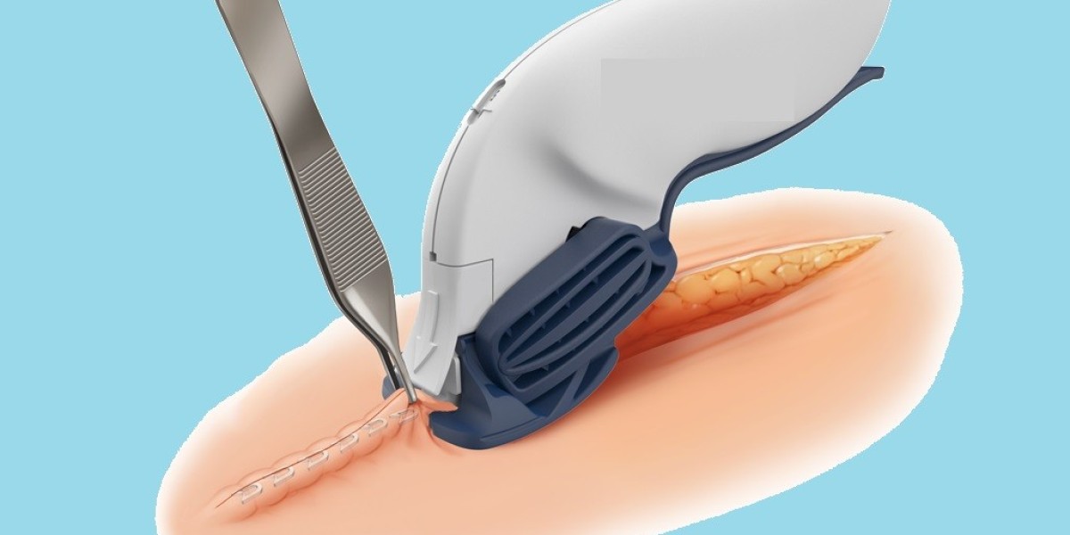 Exploring Surgical Staplers: Opportunities in Modern Healthcare