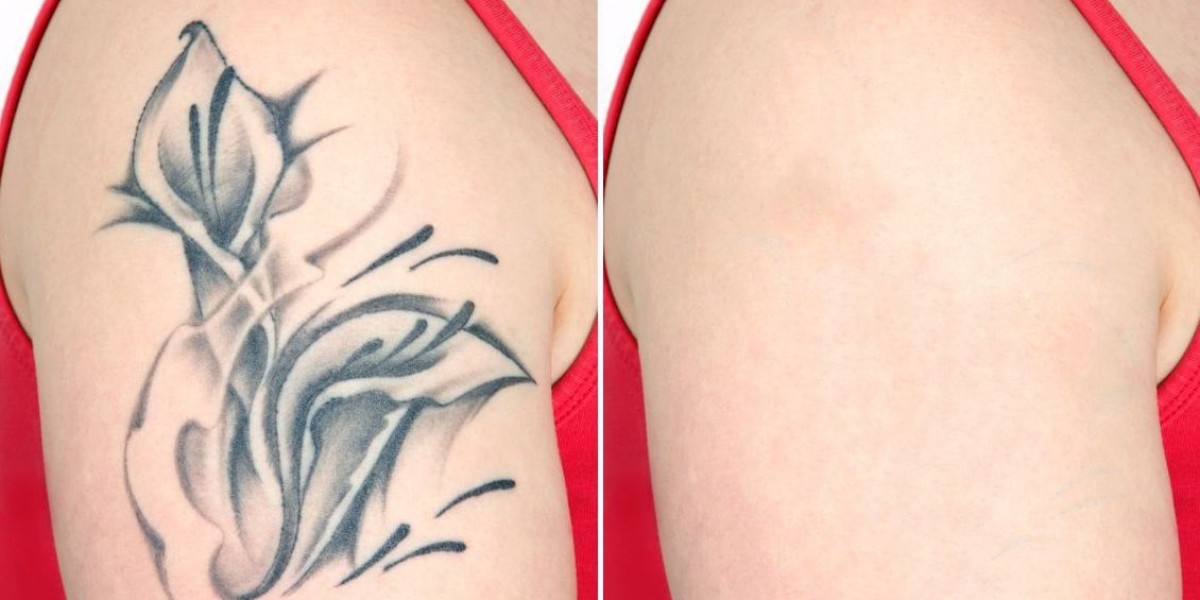 Erasing Ink: The Science Behind Laser Tattoo Removal