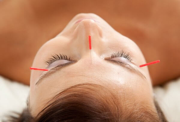 Cosmetic Acupuncture Milton, Mississauga, Oakville