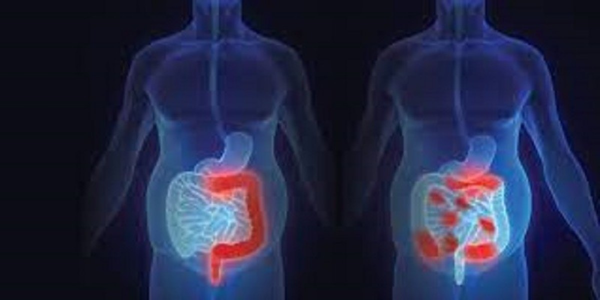Latest 2024 "Crohn's Disease Market" Report & Forecast by 2034