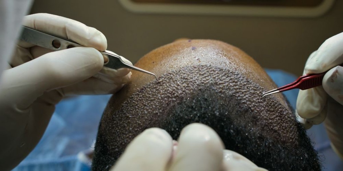 Enhancing Confidence with Hair Transplant in Lahore
