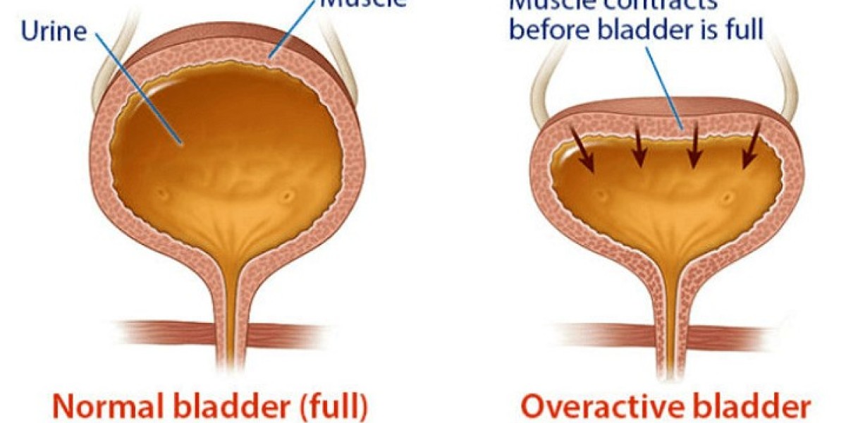 Overactive Bladder Market Report: Epidemiology, Trends and Forecast to (2024-2034)
