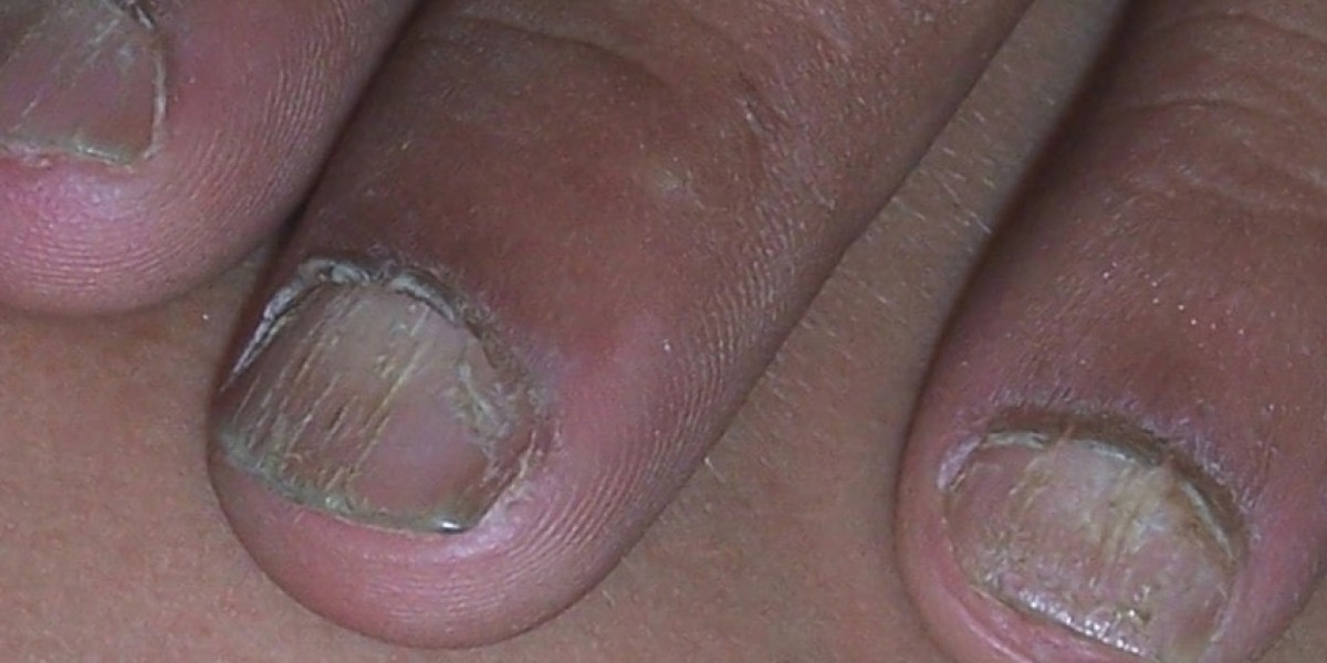 Why is ingrown toenail removal essential?