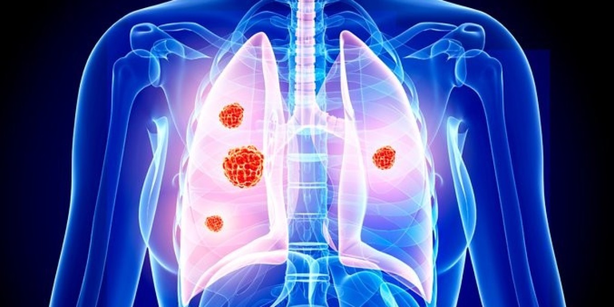 Non-Small Cell Lung Cancer (NSCLC) Market Share 2024 | Forecast till 2034