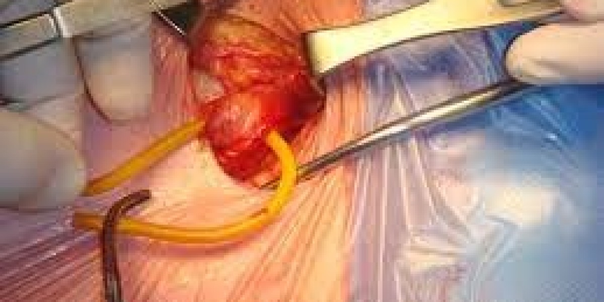 Inguinal Hernia Market Size, Trends And Forecast To 2034