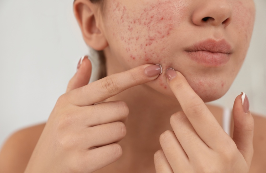 What are the Best Treatments for Acne and Skin Aging?