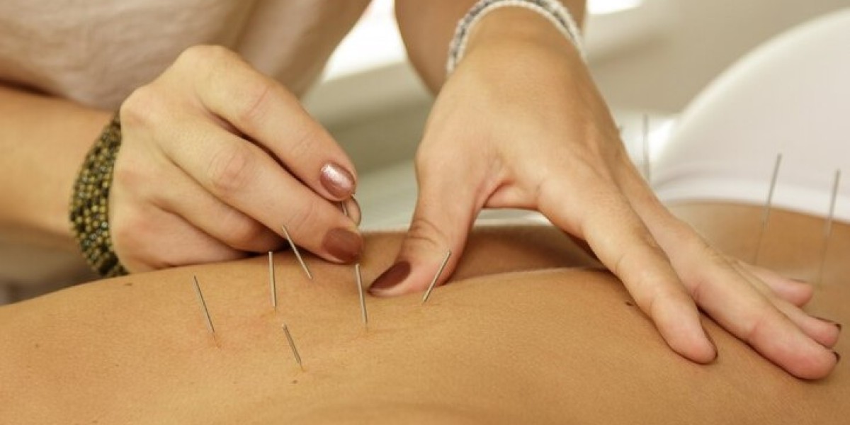 Discover Acupuncture for Weight Loss in Singapore