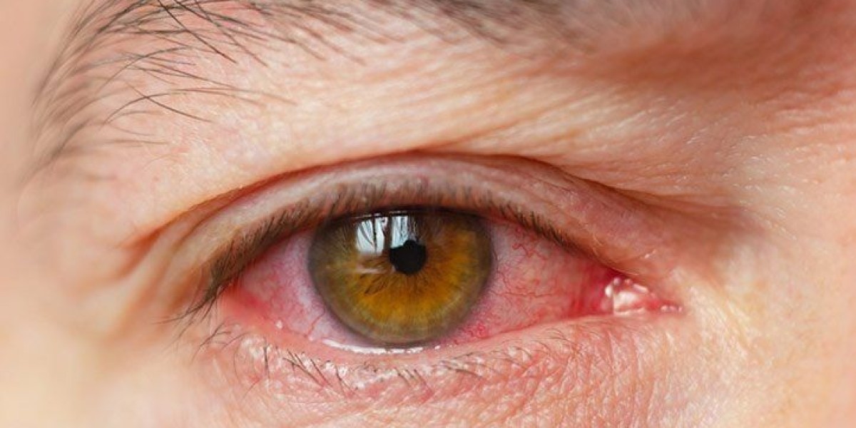 Dry Eye Disease Market Size, Trends And Forecast To 2034