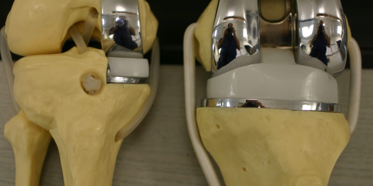 Total Knee Arthroplasty: An Overview of the Procedure, Process and Post-Surgery Recovery