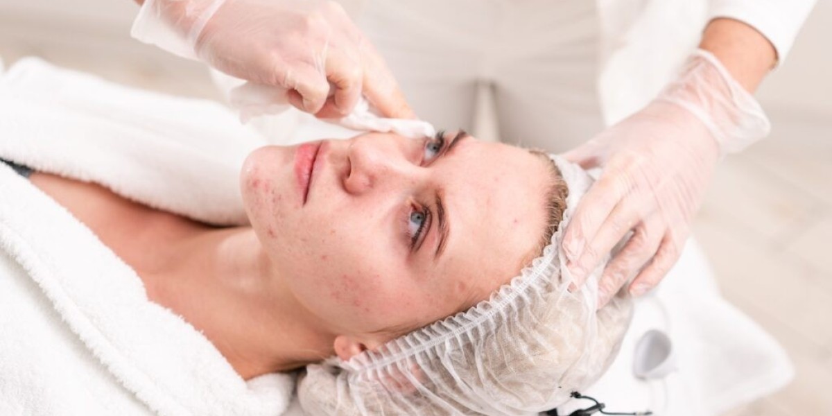 Acne Treatment for Teens: Dubai’s Top Solutions