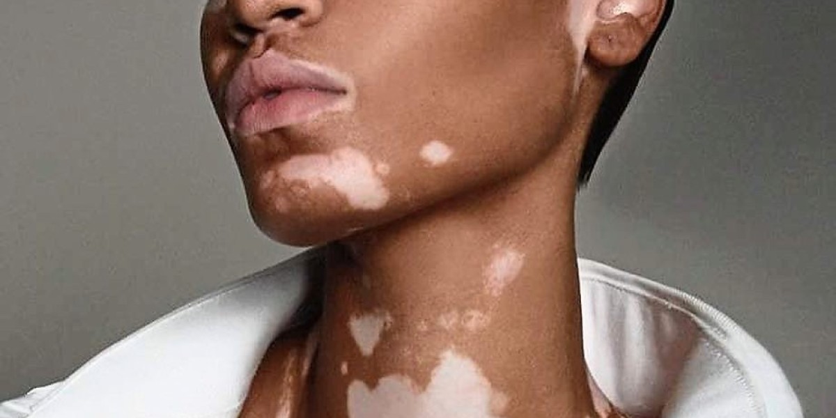 Vitiligo Market Share, Epidemiology, Analysis & Trends 2024-2034