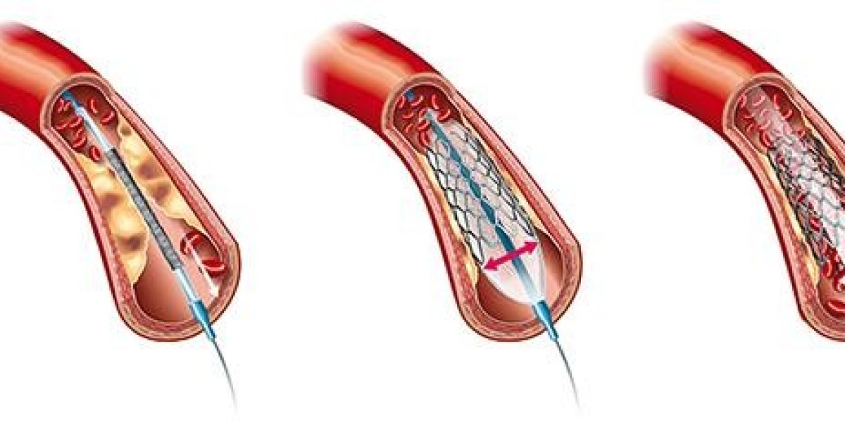 Peripheral Angiography: A Glimpse into Your Vascular Health in Jaipur