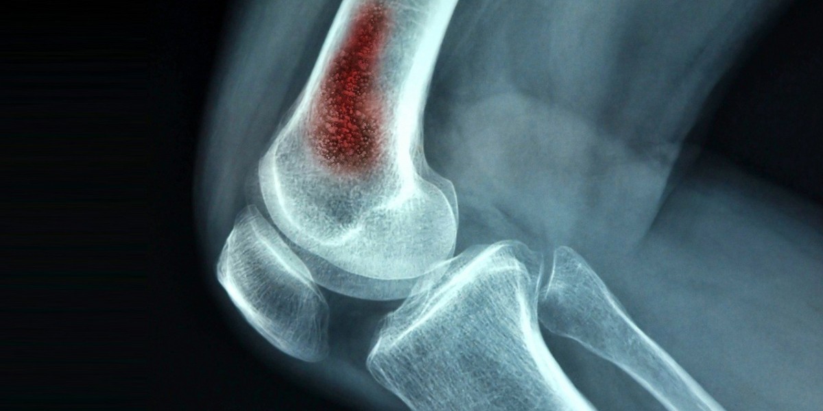 Osteomyelitis Market Report: Epidemiology, Trends and Forecast to (2024-2034)