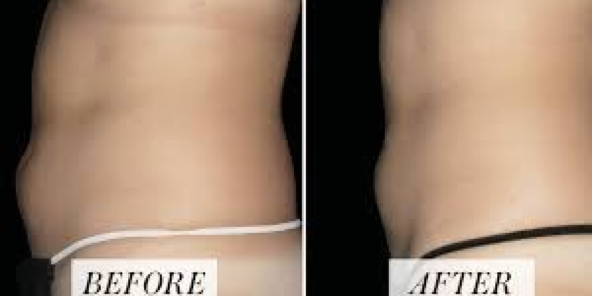 Liposuction Surgery in Lahore: A Comprehensive Guide