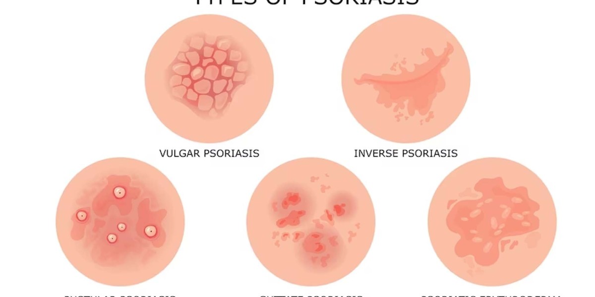 Plaque Psoriasis Market: Epidemiology, Size, Share, Analysis and Forecast till (2024-2034)